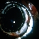 Surgical excision of tumor Surgical excision of tumor